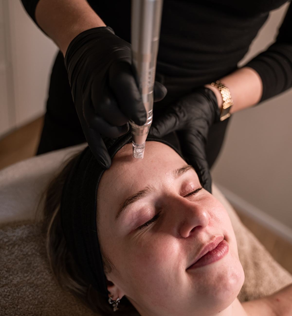SPA Microneedling bij Skin and Glow