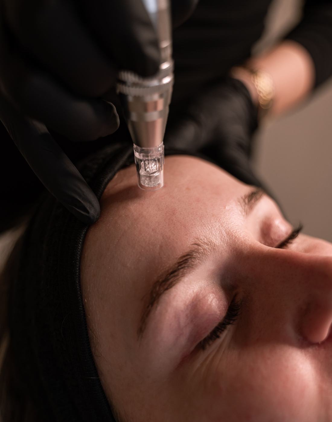 Microneedling van dichtbij
