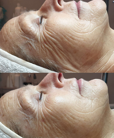 Voor en na resultaat van een Lactic Acid Peel na twee behandelingen