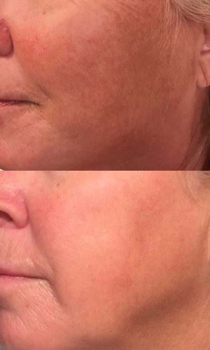 Voor en na resultaat van een Sensitive Peel na vier behandelingen